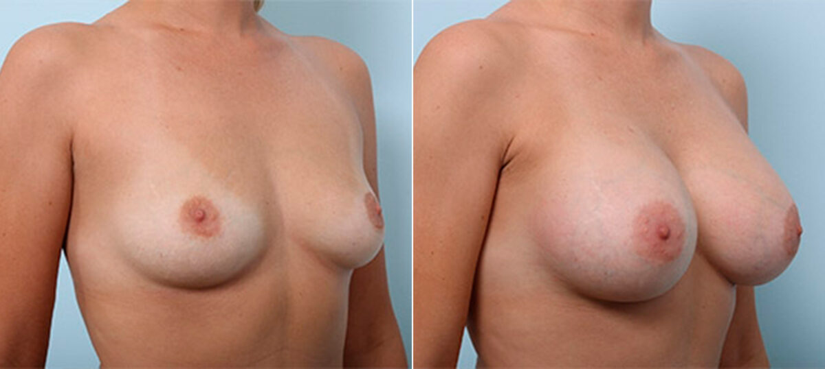 Breast Augmentation before and after photos in Houston, TX, Patient 26361