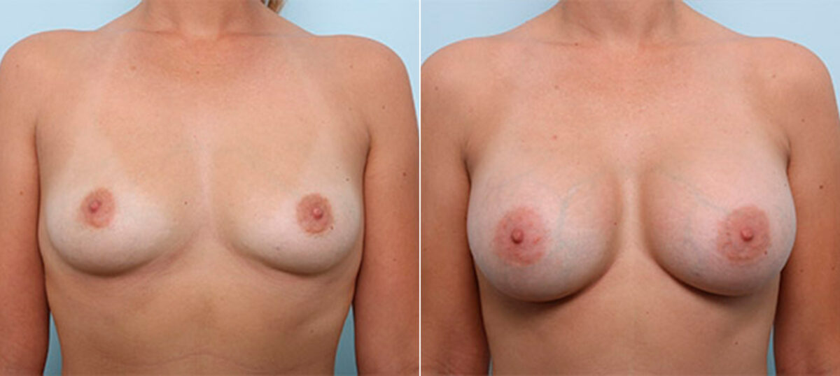 Breast Augmentation before and after photos in Houston, TX, Patient 26361