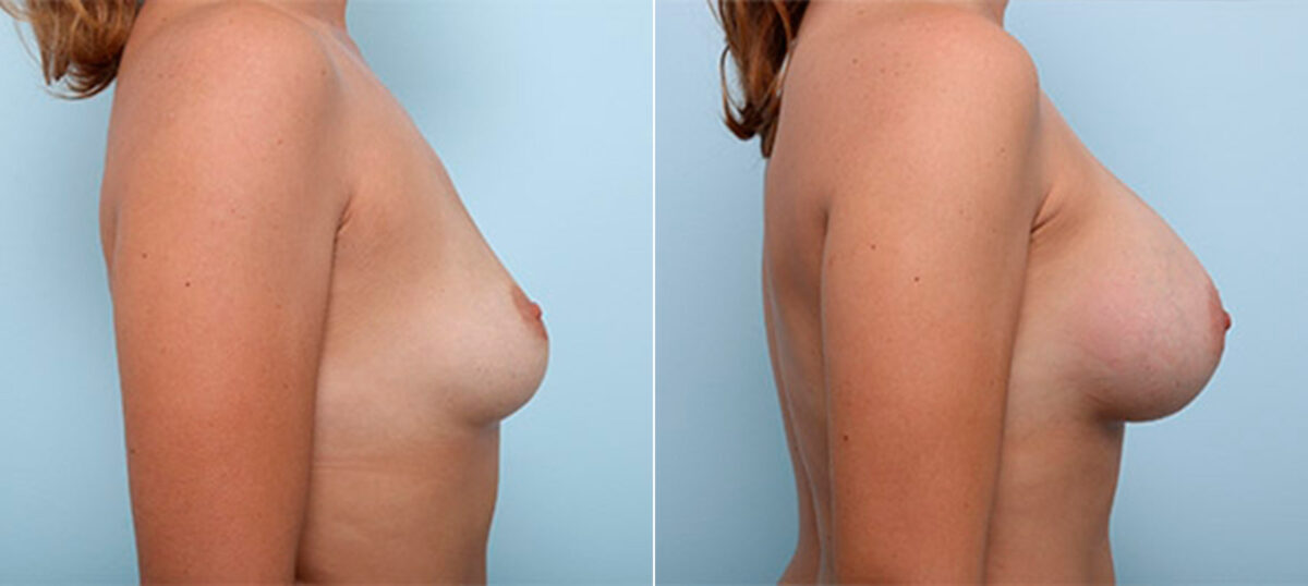 Breast Augmentation before and after photos in Houston, TX, Patient 26361