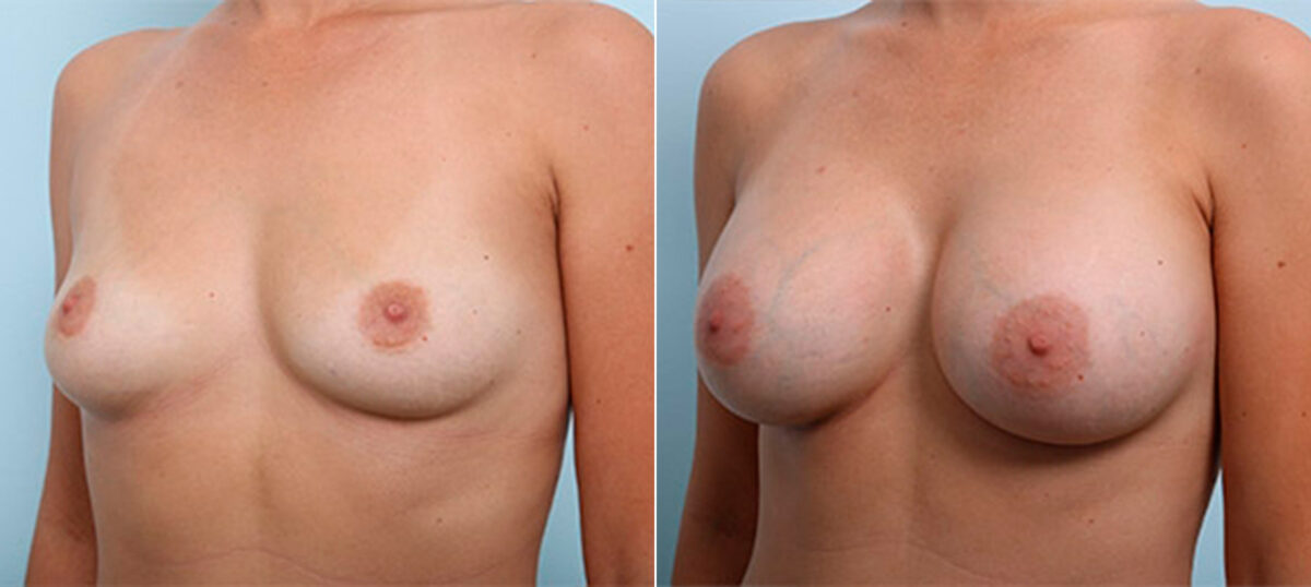 Breast Augmentation before and after photos in Houston, TX, Patient 26361