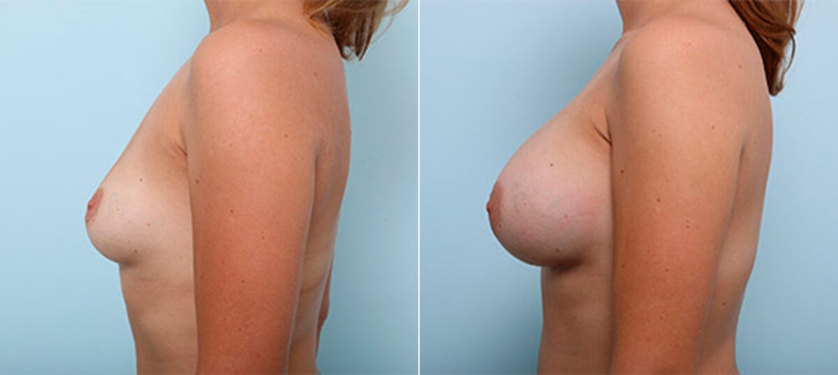 Breast Augmentation before and after photos in Houston, TX, Patient 26361