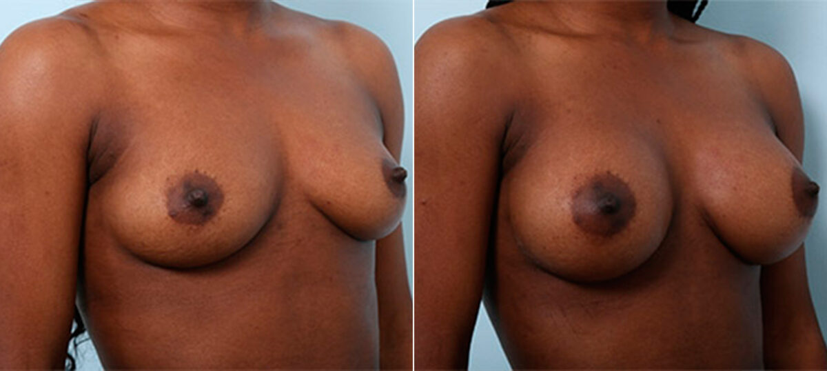 Breast Augmentation before and after photos in Houston, TX, Patient 26372