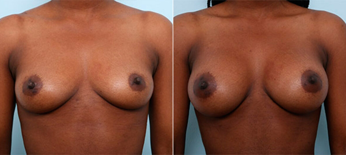 Breast Augmentation before and after photos in Houston, TX, Patient 26372