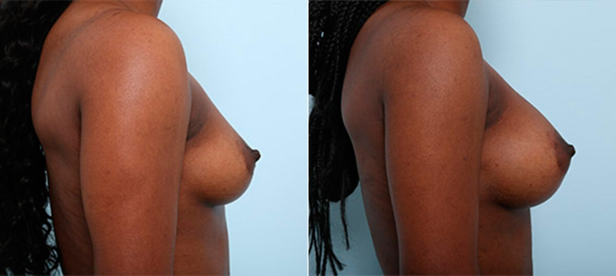 Breast Augmentation before and after photos in Houston, TX, Patient 26372