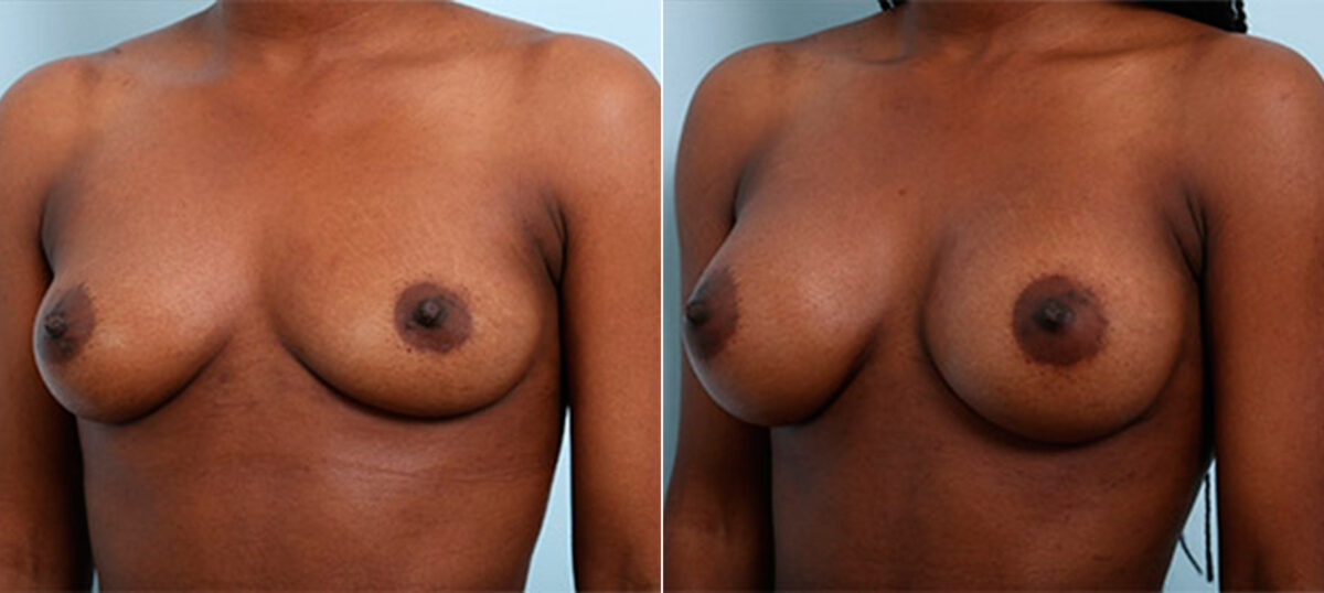 Breast Augmentation before and after photos in Houston, TX, Patient 26372