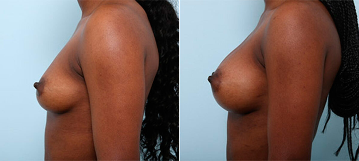 Breast Augmentation before and after photos in Houston, TX, Patient 26372