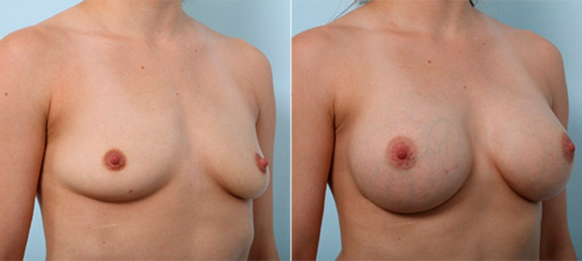 Breast Augmentation before and after photos in Houston, TX, Patient 26383