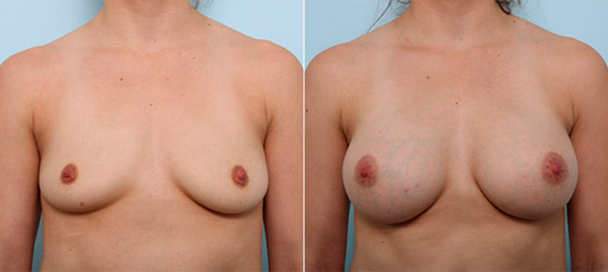 Breast Augmentation before and after photos in Houston, TX, Patient 26383