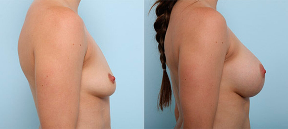 Breast Augmentation before and after photos in Houston, TX, Patient 26383