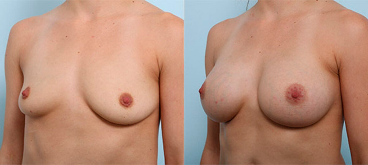 Breast Augmentation before and after photos in Houston, TX, Patient 26383