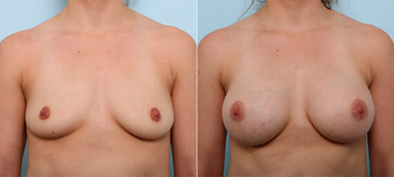 Breast Augmentation before and after photos in Houston, TX, Patient 26383