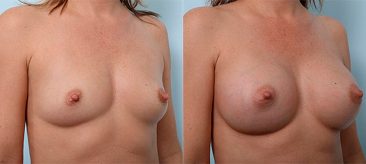 Breast Augmentation before and after photos in Houston, TX, Patient 26394