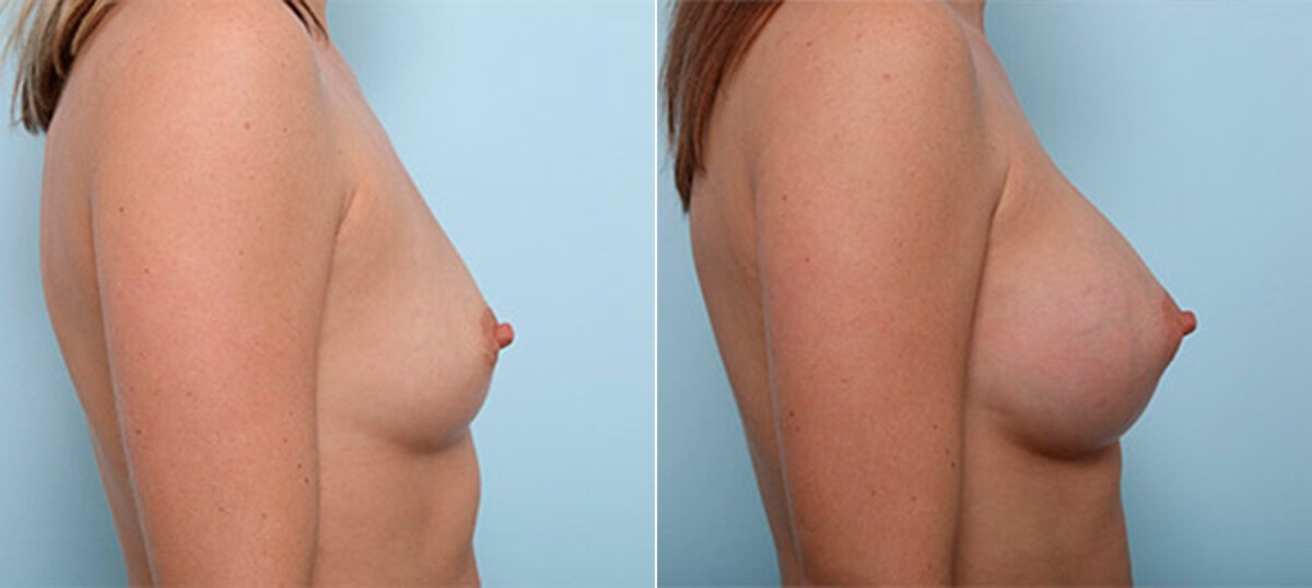 Breast Augmentation before and after photos in Houston, TX, Patient 26394
