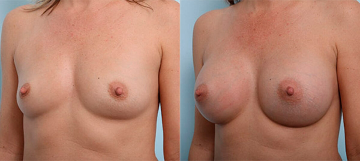 Breast Augmentation before and after photos in Houston, TX, Patient 26394