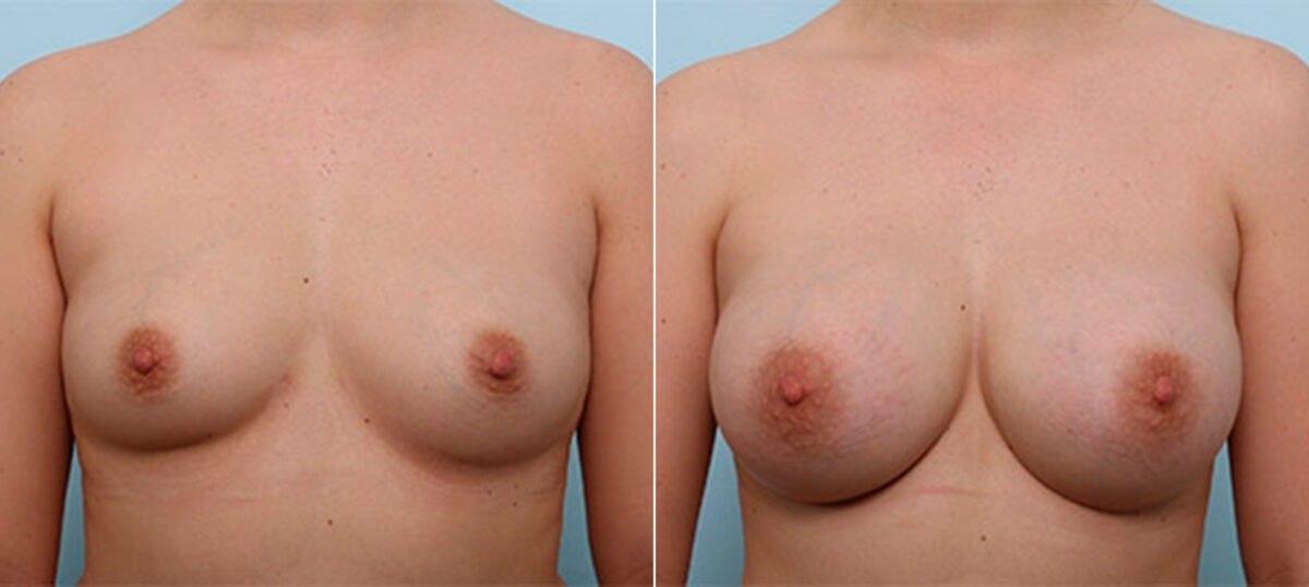 Breast Augmentation before and after photos in Houston, TX, Patient 26405