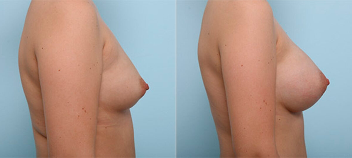 Breast Augmentation before and after photos in Houston, TX, Patient 26405