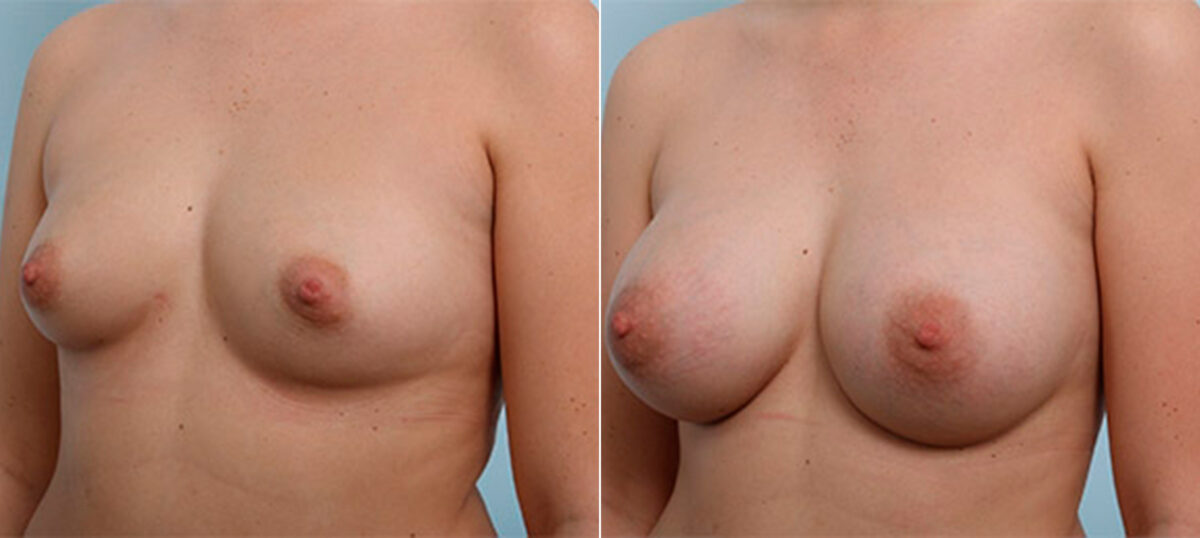 Breast Augmentation before and after photos in Houston, TX, Patient 26405