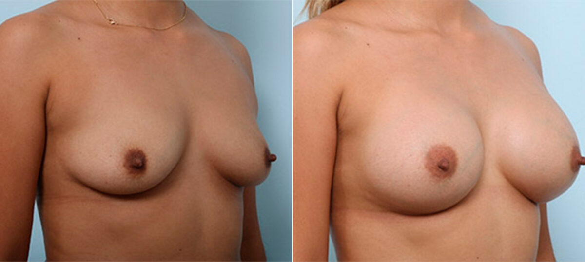 Breast Augmentation before and after photos in Houston, TX, Patient 26416