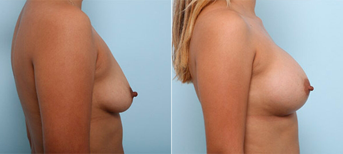 Breast Augmentation before and after photos in Houston, TX, Patient 26416