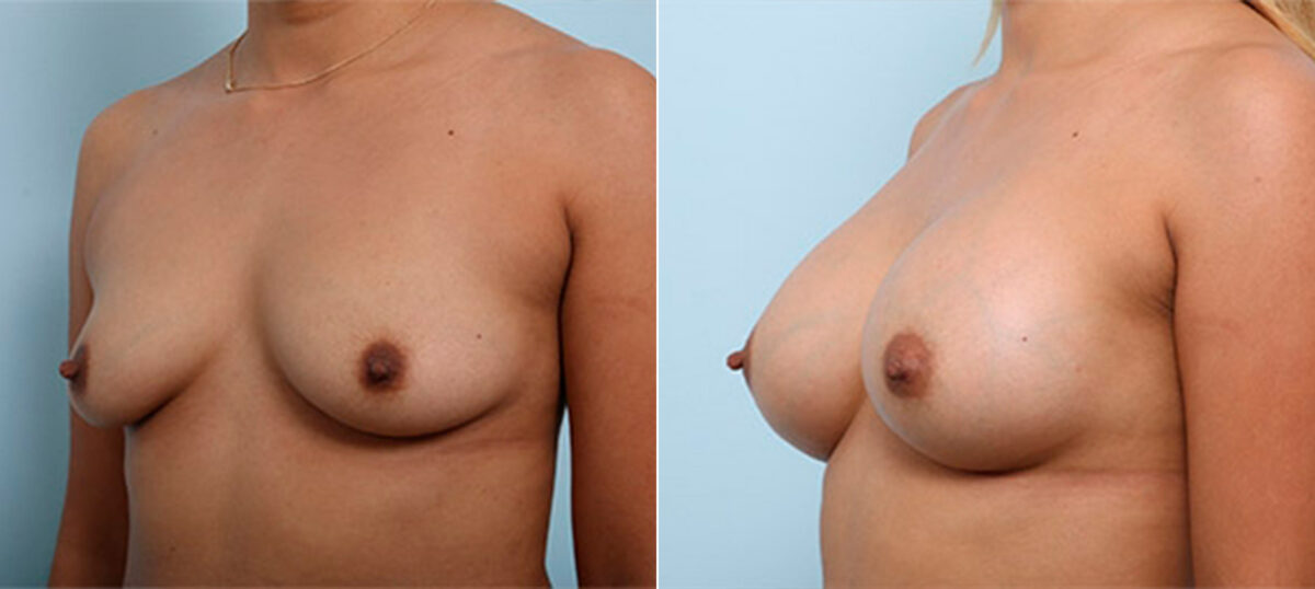 Breast Augmentation before and after photos in Houston, TX, Patient 26416