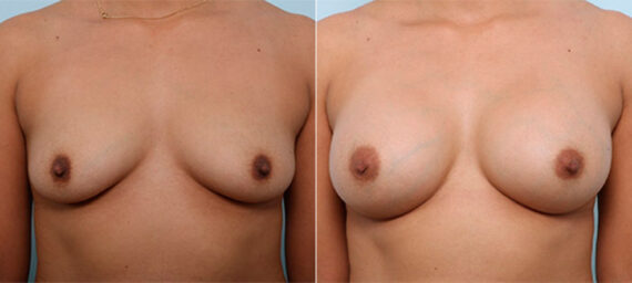 Breast Augmentation before and after photos in Houston, TX, Patient 26416