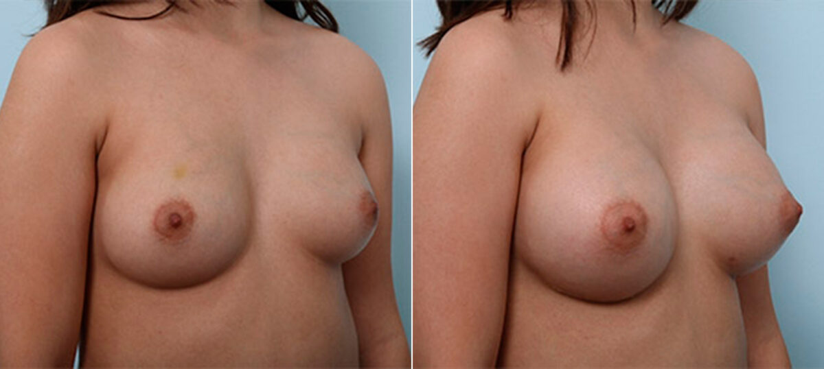 Breast Augmentation before and after photos in Houston, TX, Patient 26427
