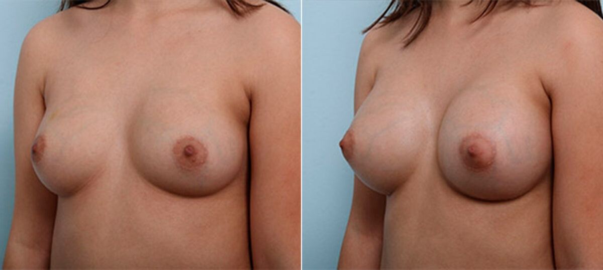 Breast Augmentation before and after photos in Houston, TX, Patient 26427