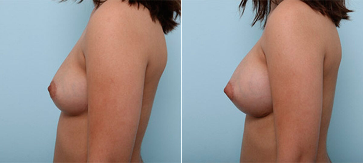 Breast Augmentation before and after photos in Houston, TX, Patient 26427