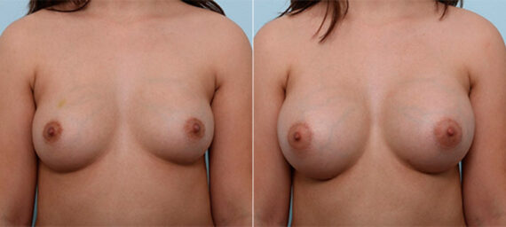 Breast Augmentation before and after photos in Houston, TX, Patient 26427