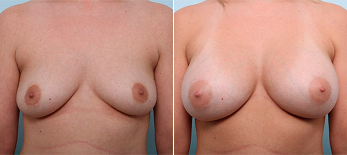 Breast Augmentation before and after photos in Houston, TX, Patient 26438