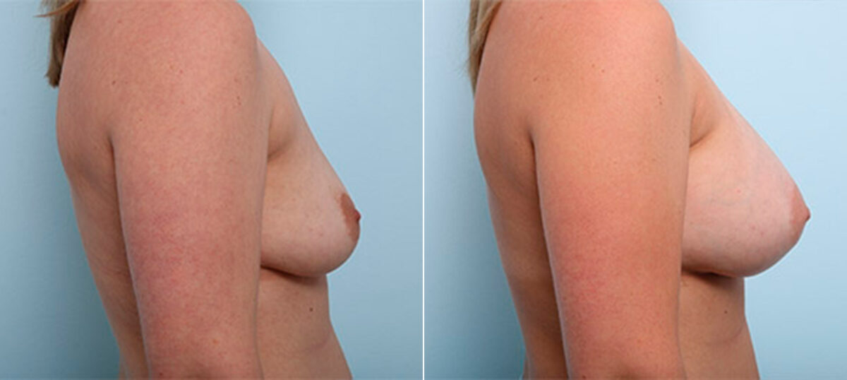 Breast Augmentation before and after photos in Houston, TX, Patient 26438
