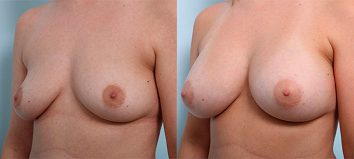 Breast Augmentation before and after photos in Houston, TX, Patient 26438