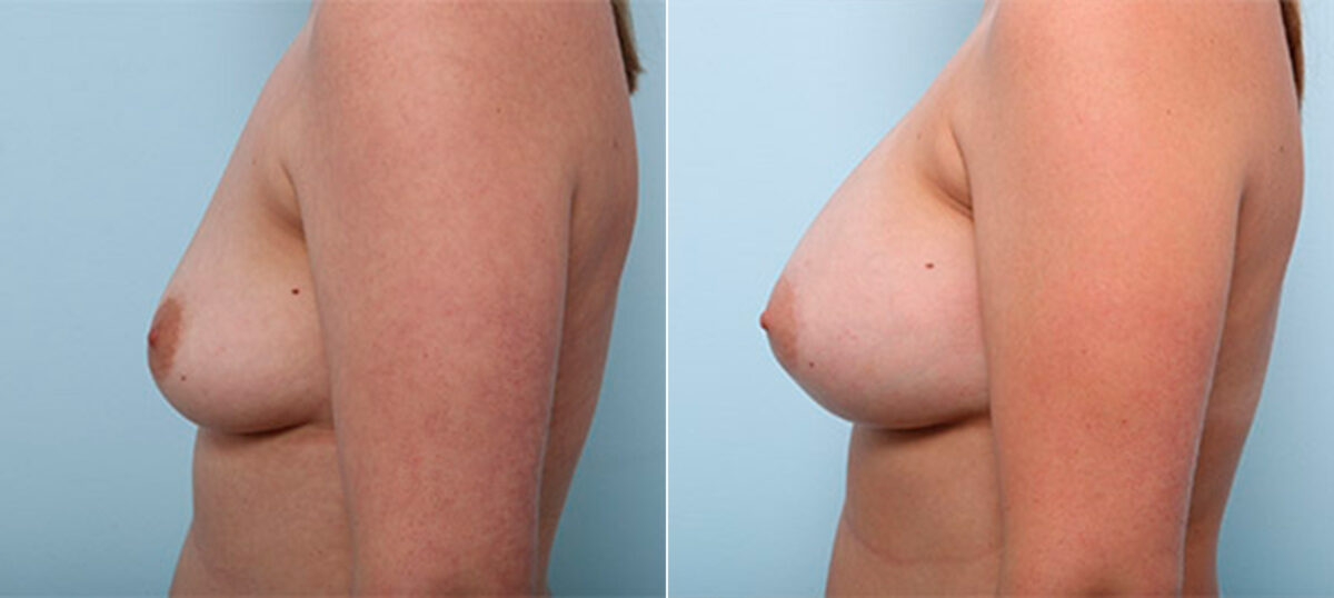 Breast Augmentation before and after photos in Houston, TX, Patient 26438