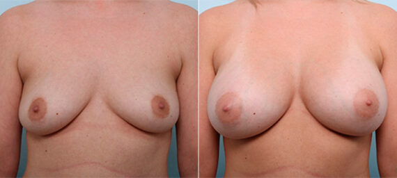Breast Augmentation before and after photos in Houston, TX, Patient 26438