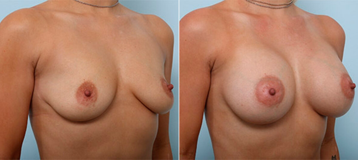 Breast Augmentation before and after photos in Houston, TX, Patient 26449