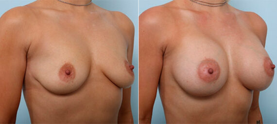 Breast Augmentation before and after photos in Houston, TX, Patient 26449