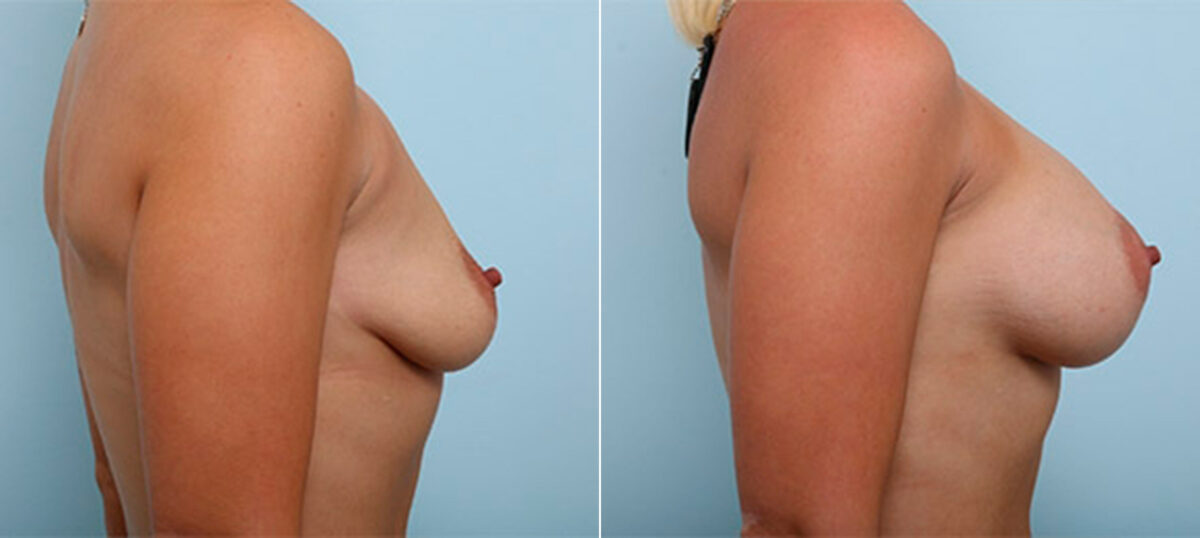 Breast Augmentation before and after photos in Houston, TX, Patient 26449