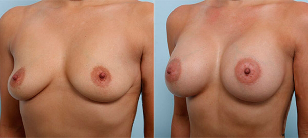 Breast Augmentation before and after photos in Houston, TX, Patient 26449