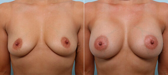 Breast Augmentation before and after photos in Houston, TX, Patient 26449