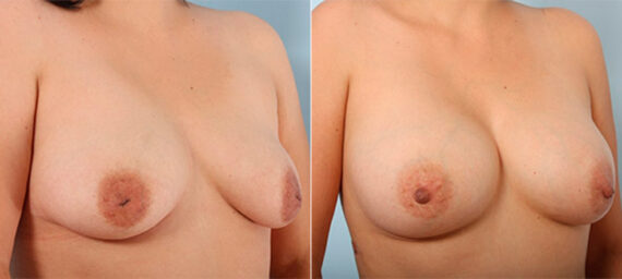 Breast Augmentation before and after photos in Houston, TX, Patient 26460