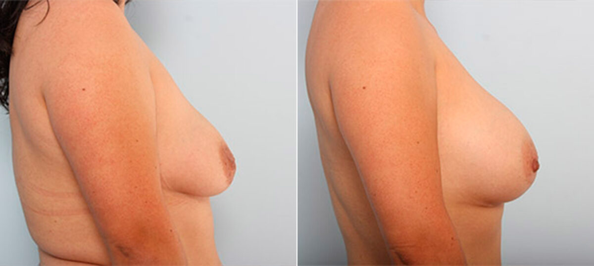 Breast Augmentation before and after photos in Houston, TX, Patient 26460