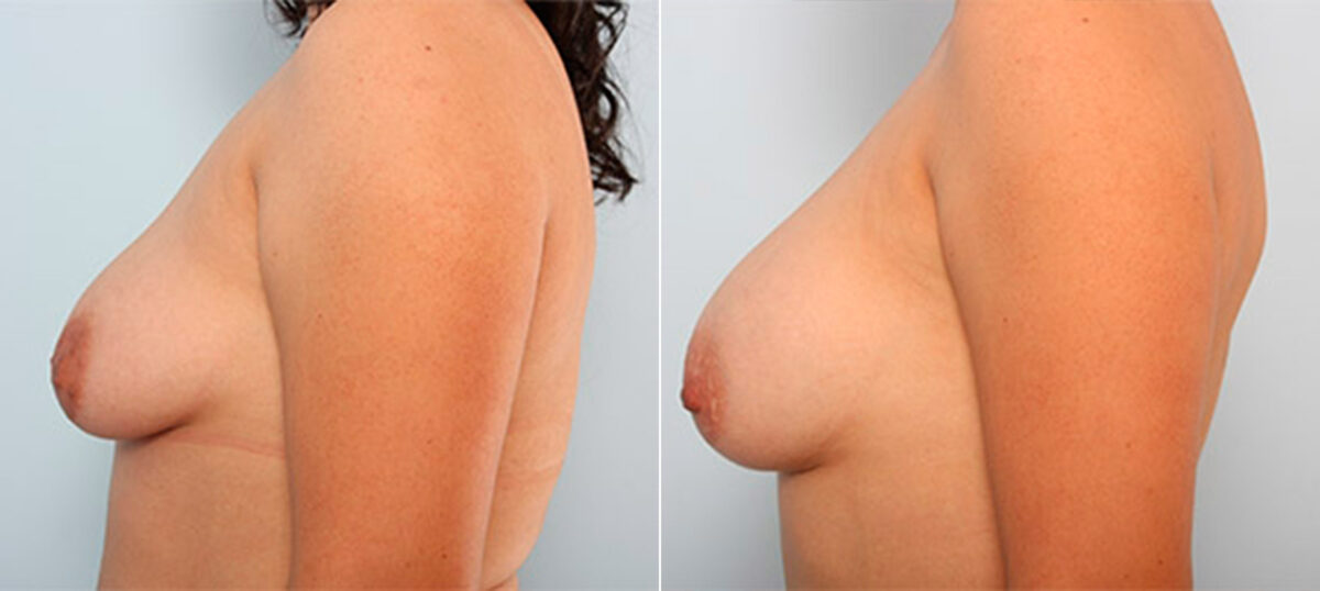 Breast Augmentation before and after photos in Houston, TX, Patient 26460
