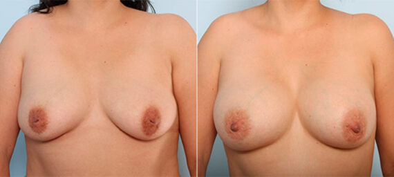 Breast Augmentation before and after photos in Houston, TX, Patient 26460