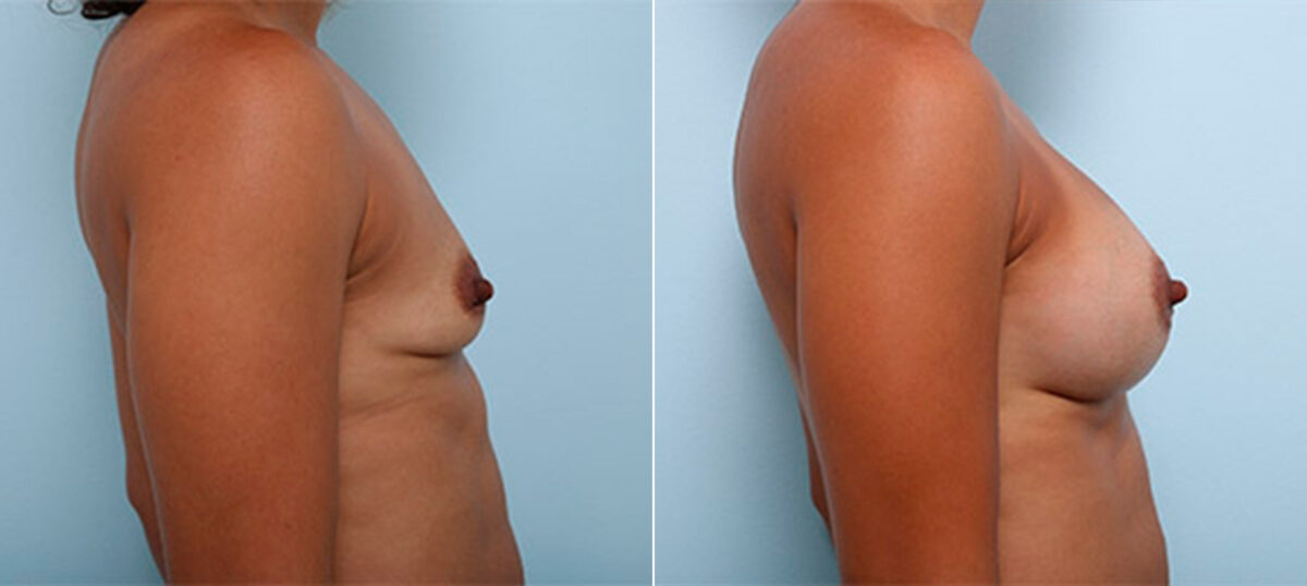 Breast Augmentation before and after photos in Houston, TX, Patient 26472