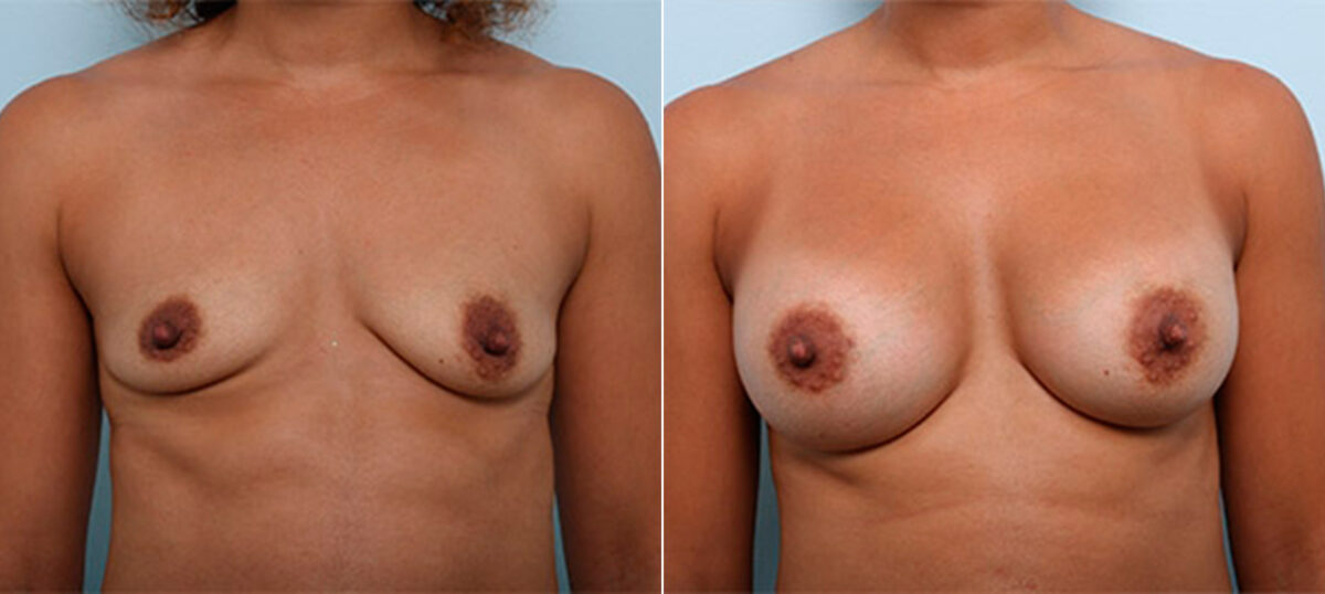 Breast Augmentation before and after photos in Houston, TX, Patient 26472