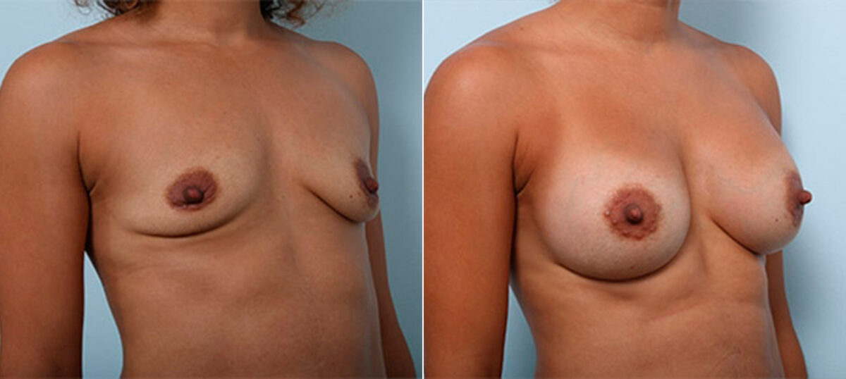 Breast Augmentation before and after photos in Houston, TX, Patient 26472