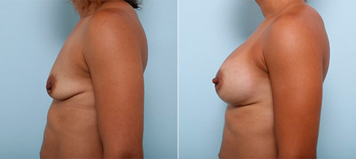 Breast Augmentation before and after photos in Houston, TX, Patient 26472