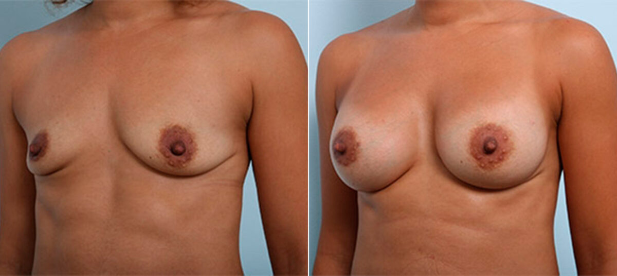 Breast Augmentation before and after photos in Houston, TX, Patient 26472