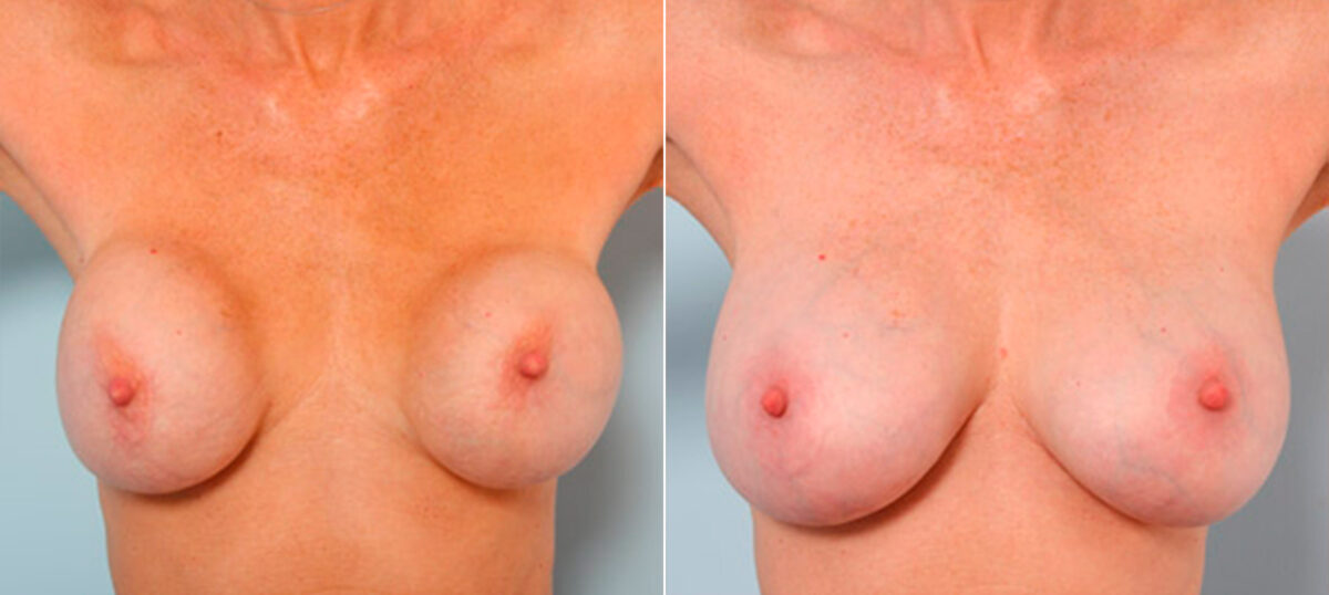 Breast Revision with Strattice before and after photos in Houston, TX, Patient 27152