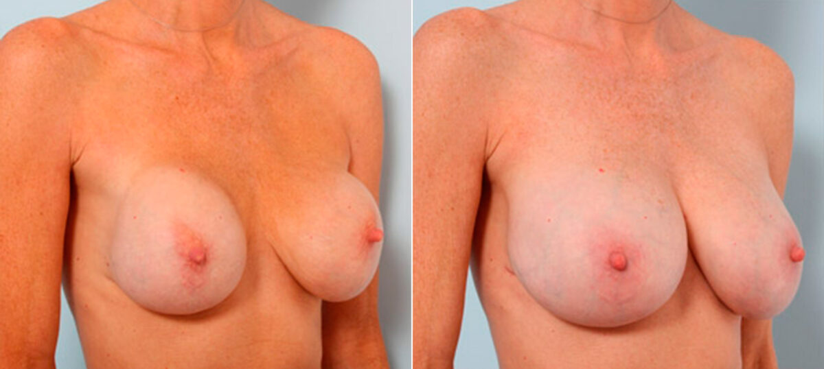 Breast Revision with Strattice before and after photos in Houston, TX, Patient 27152
